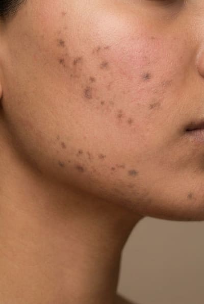Illustration of reddened skin with darker marks left behind by flushing