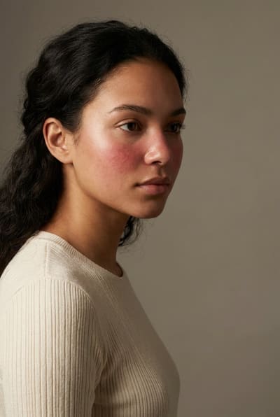Illustration of redness on skin — reactive flushing across the cheeks